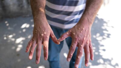 Dünya Sağlık Örgütü (DSÖ), Afrika'da yayılan maymun çiçeği (mpox) virüsü