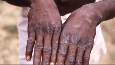 Güney Afrika ülkeleri Zimbabve ve Zambiya'da, ilk Maymun çiçeği vakalarının