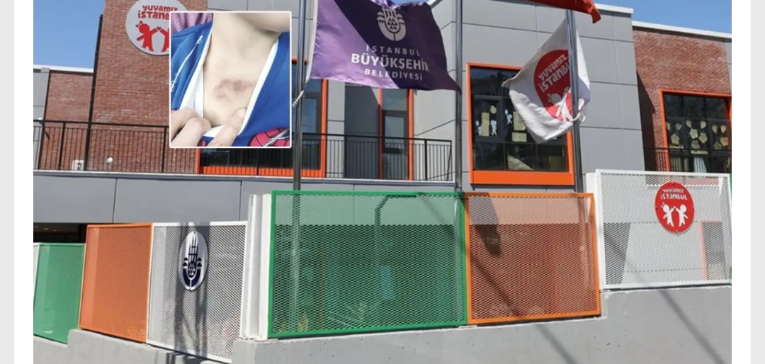 İBB'nin Eyüpsultan'daki kreşinde, 3 yaşındaki bir çocuğun vücudundaki morluklar ağır