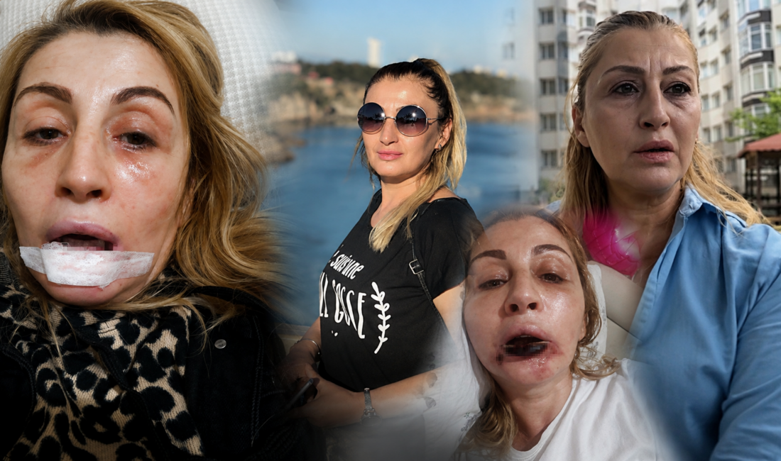 Antalya'da estetik işlem sonrası dudağında doku kaybı oluştuğunu öne süren