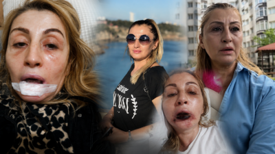Antalya'da estetik işlem sonrası dudağında doku kaybı oluştuğunu öne süren