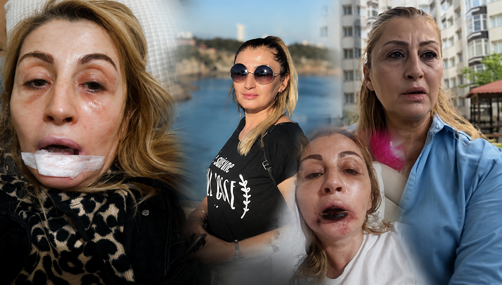 Antalya'da estetik işlem sonrası dudağında doku kaybı oluştuğunu öne süren